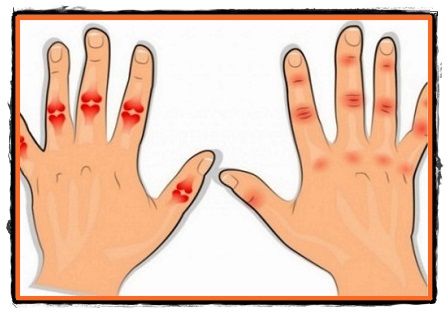 artroza articulațiilor de pe degete